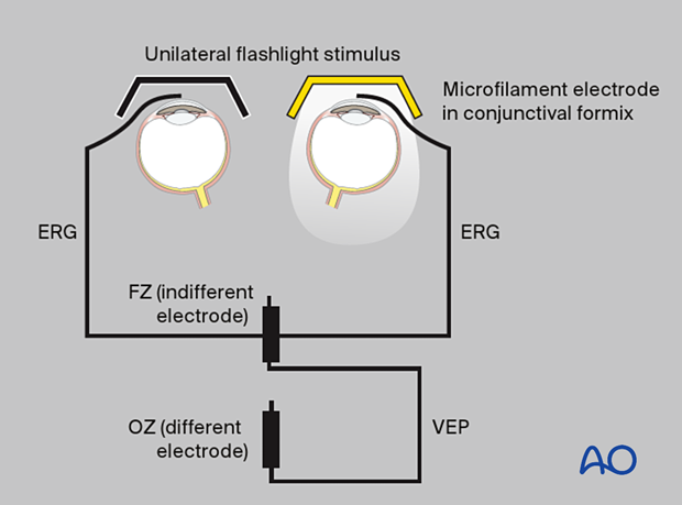 examination of patients with midfacial injuries - Visual evoked potential (VEP)
