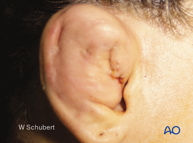 examination of patients with midfacial injuries – ear examination