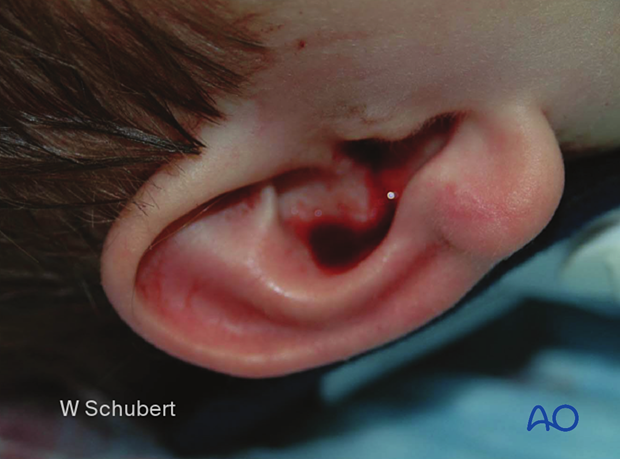 examination of patients with midfacial injuries – ear examination