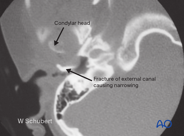 examination of patients with midfacial injuries – ear examination