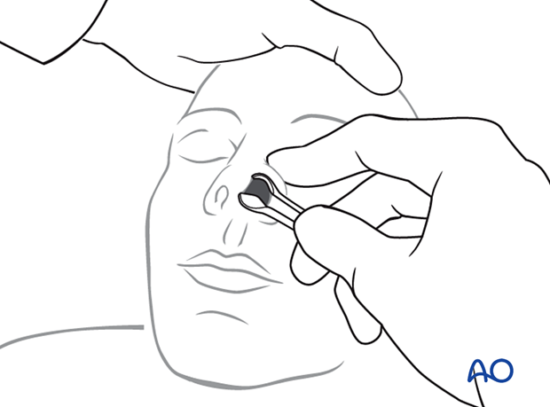 examination of patients with midfacial injuries – nasal examination
