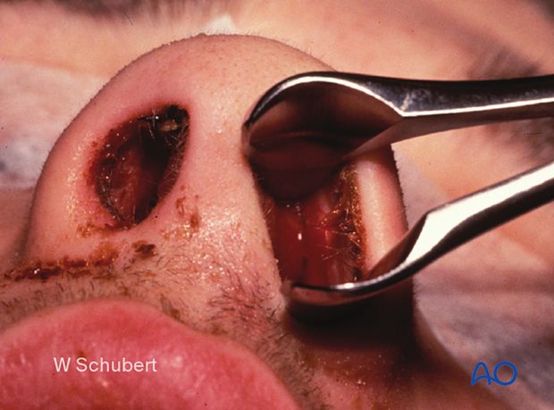 examination of patients with midfacial injuries – nasal examination