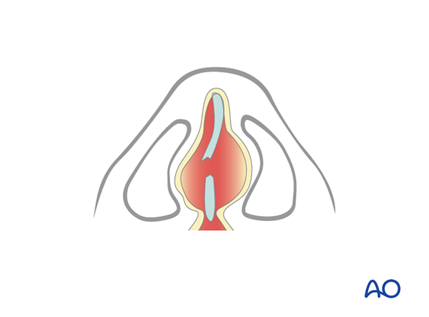 examination of patients with midfacial injuries – nasal examination