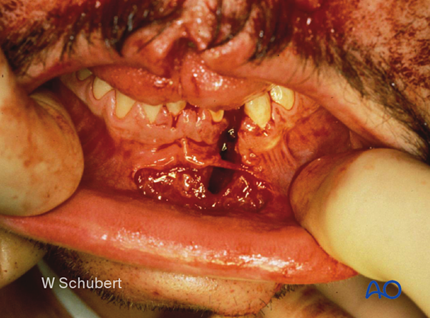 examination of patients with midfacial injuries – oral/throat examination