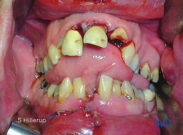 examination of patients with midfacial injuries – oral/throat examination