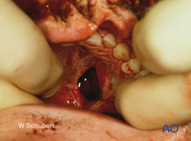 examination of patients with midfacial injuries – oral/throat examination