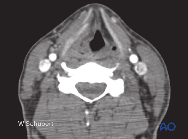 examination of patients with midfacial injuries – neck examination