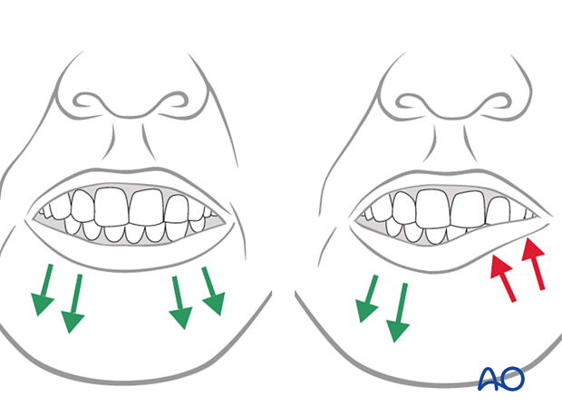 examination of patients with midfacial injuries – sensory and motor examination of the face
