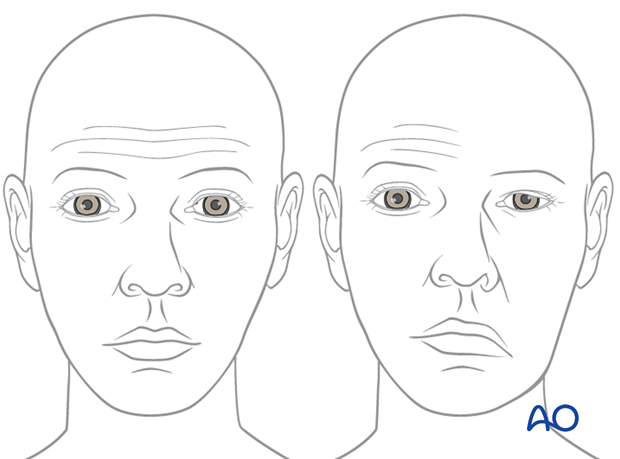 examination of patients with midfacial injuries – sensory and motor examination of the face