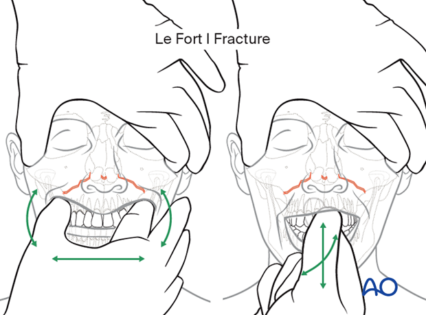 examination of patients with midfacial injuries – fracture palpation