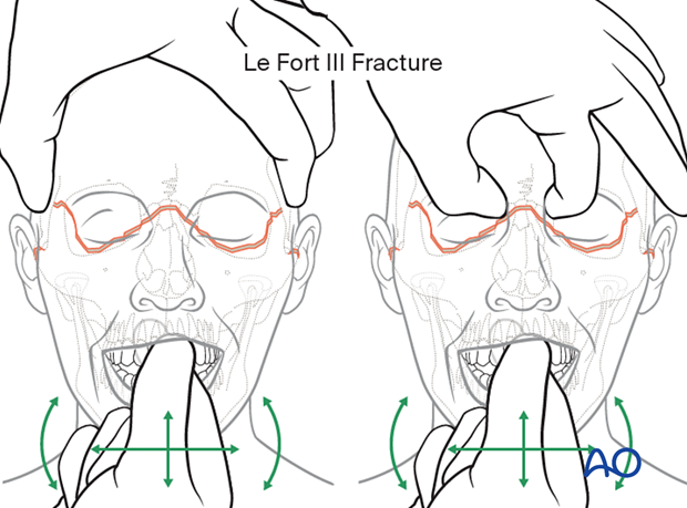 examination of patients with midfacial injuries – fracture palpation