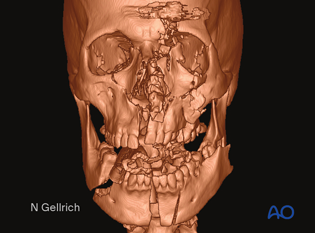 examination of patients with midfacial injuries – radiological findings