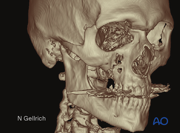 examination of patients with midfacial injuries – radiological findings