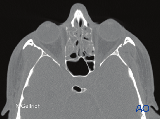 examination of patients with midfacial injuries – radiological findings