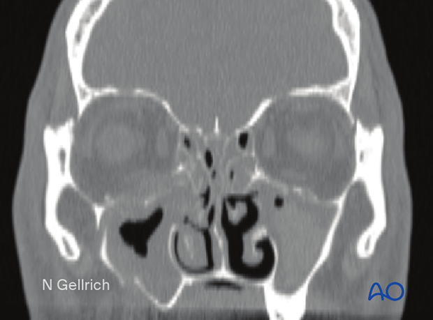 examination of patients with midfacial injuries – radiological findings