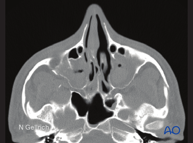 examination of patients with midfacial injuries – radiological findings