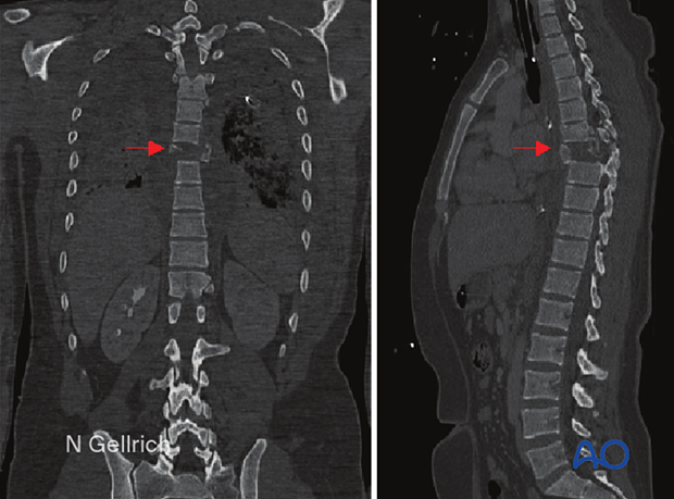examination of patients with midfacial injuries – radiological findings