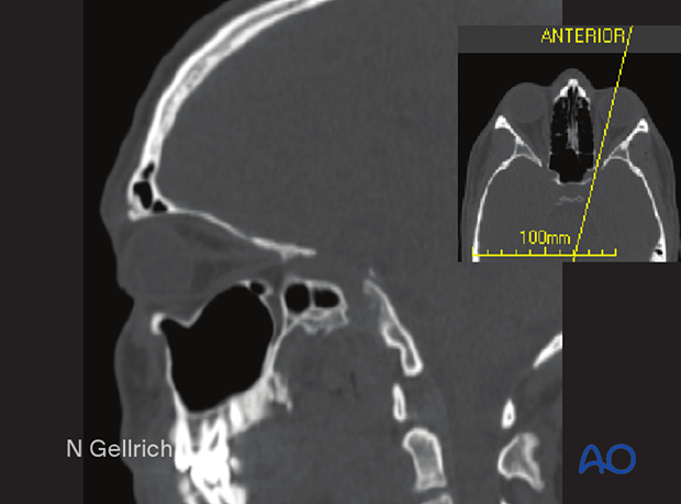 examination of patients with midfacial injuries – radiological findings