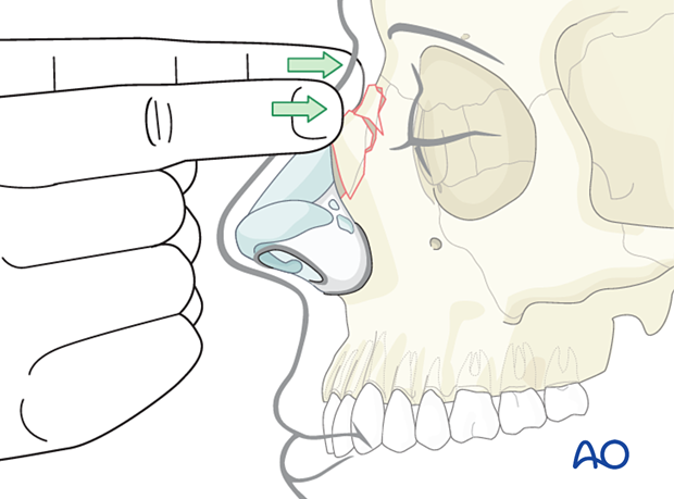 Diagnosis of nasal fractures - physical examination