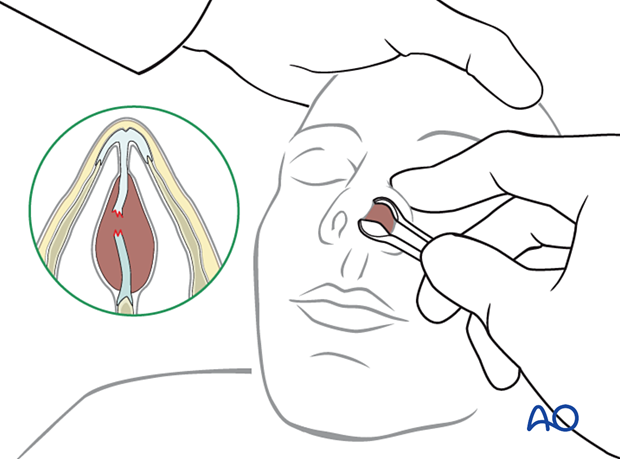 Diagnosis of nasal fractures - physical examination