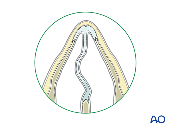 Diagnosis of nasal fractures - physical examination