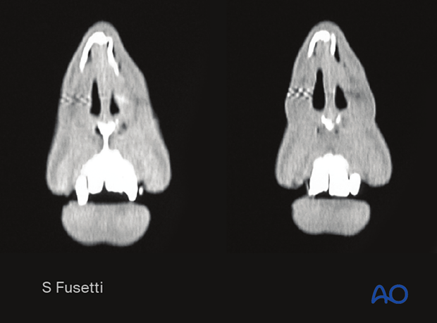 Diagnosis of nasal fractures - imaging 