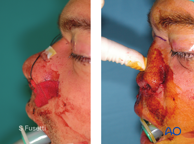 Examination of patients with NOE fractures - clinical examination