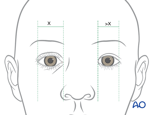 Examination of patients with NOE fractures - intercanthal distance