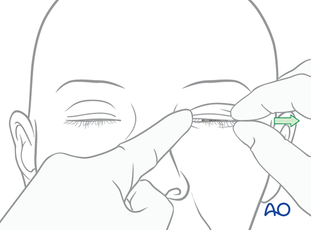 Examination of patients with NOE fractures - bow-string test