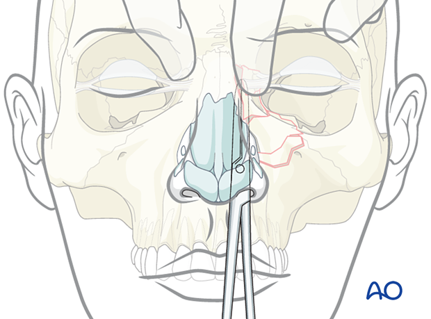 Examination of patients with NOE fractures - bimanual palpation