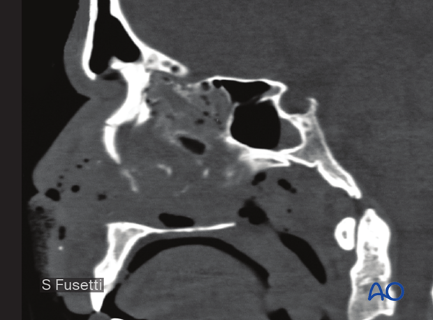 Examination of patients with NOE fractures - radiographic findings