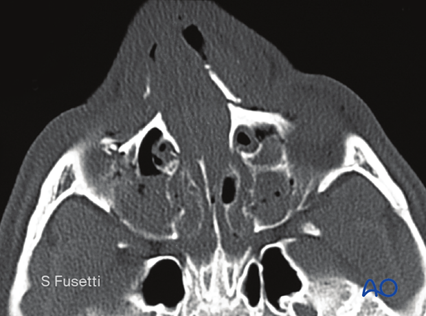 Examination of patients with NOE fractures - radiographic findings