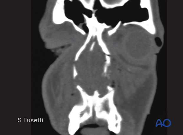 Examination of patients with NOE fractures - radiographic findings
