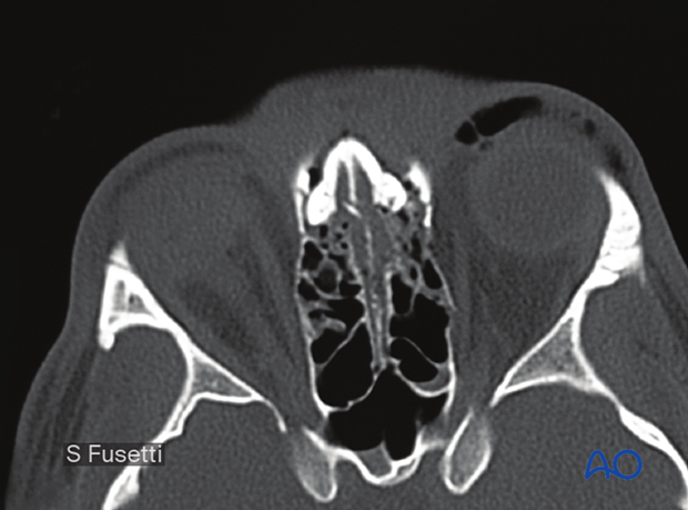 Examination of patients with NOE fractures - radiographic findings