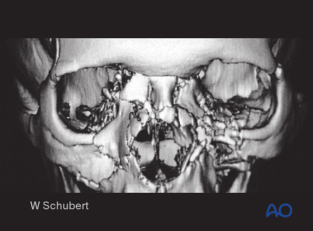 Examination of patients with NOE fractures - radiographic findings