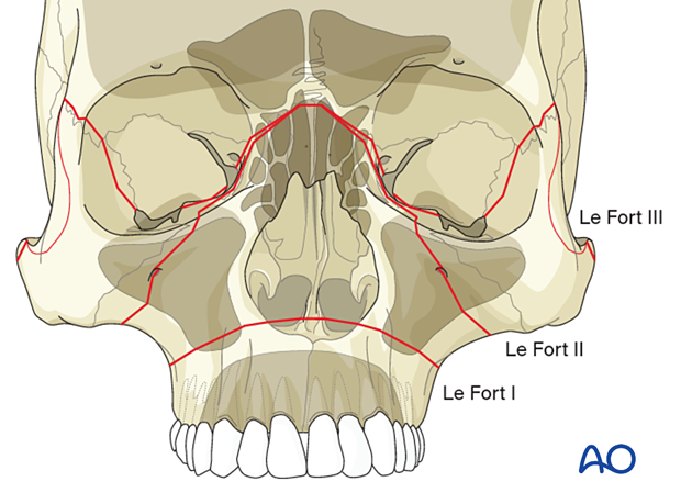 AO CMF Classification Le Fort type midface fractures