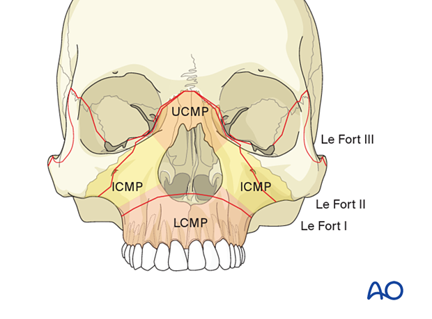 AO CMF Classification Maxillae, central midface, and partitions