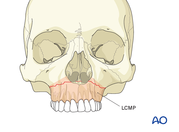 AO CMF Classification Maxillae, central midface, and partitions