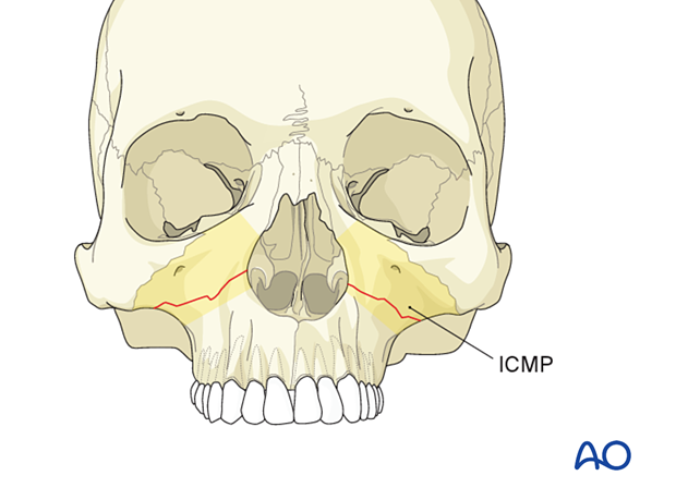 AO CMF Classification Maxillae, central midface, and partitions