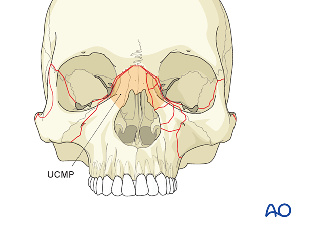 AO CMF Classification Maxillae, central midface, and partitions
