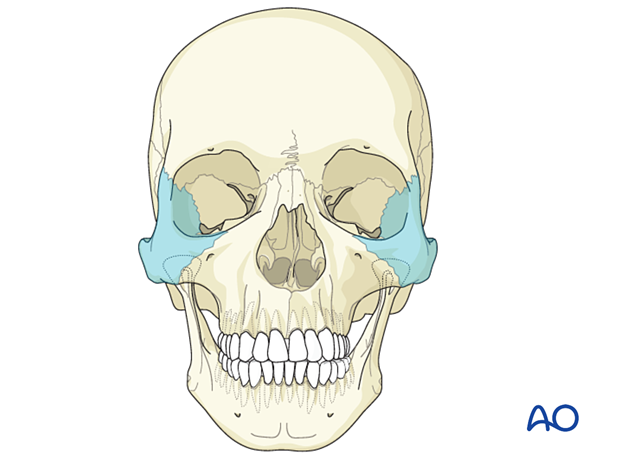 AO CMF Classification Lateral midface - zygoma