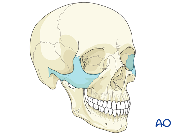 AO CMF Classification Lateral midface - zygoma