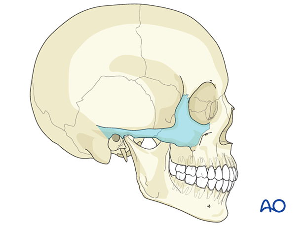 AO CMF Classification Lateral midface - zygoma