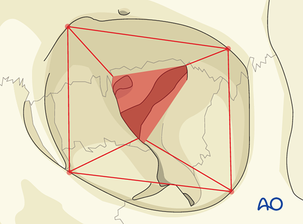 AO CMF Classification Internal orbit - orbital walls