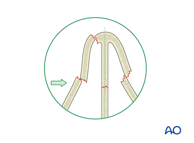 Classification of nasal bone fractures - Laterally displaced fractures
