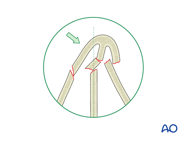 Classification of nasal bone fractures - Laterally displaced fractures 