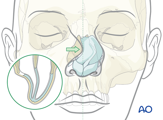 Classification of nasal bone fractures - Disarticulation of upper lateral cartilage