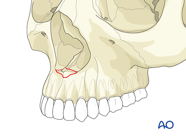 Classification of nasal bone fractures – Anterior nasal spine fracture