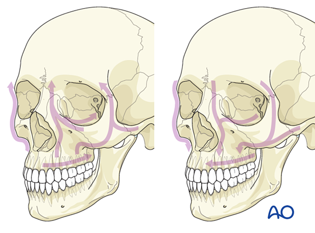 Panfacial fractures (sequencing of repair)