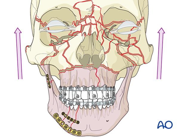 Panfacial fractures (sequencing of repair) - Principles